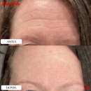 adesivo de silicone rugas, adesivo facial reutilizável, patch para rugas rosto, linhas de expressão testa, adesivo dormir rosto, skin care silicone, adesivo anti rugas, muy bela original, cuidados com a pele, adesivo lavável hipoalergênico