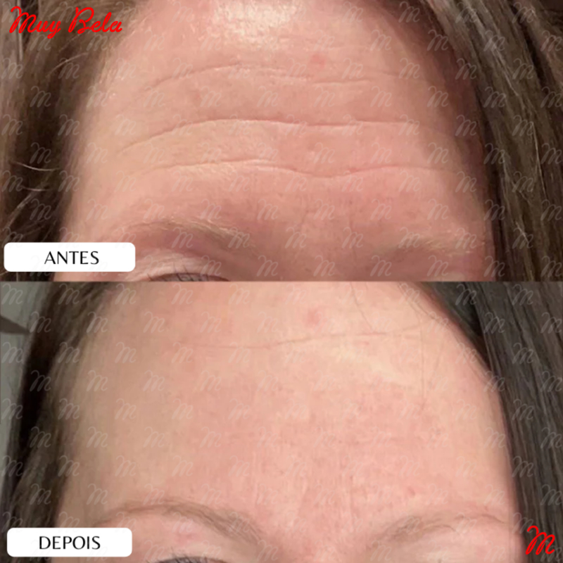 adesivo de silicone rugas, adesivo facial reutilizável, patch para rugas rosto, linhas de expressão testa, adesivo dormir rosto, skin care silicone, adesivo anti rugas, muy bela original, cuidados com a pele, adesivo lavável hipoalergênico